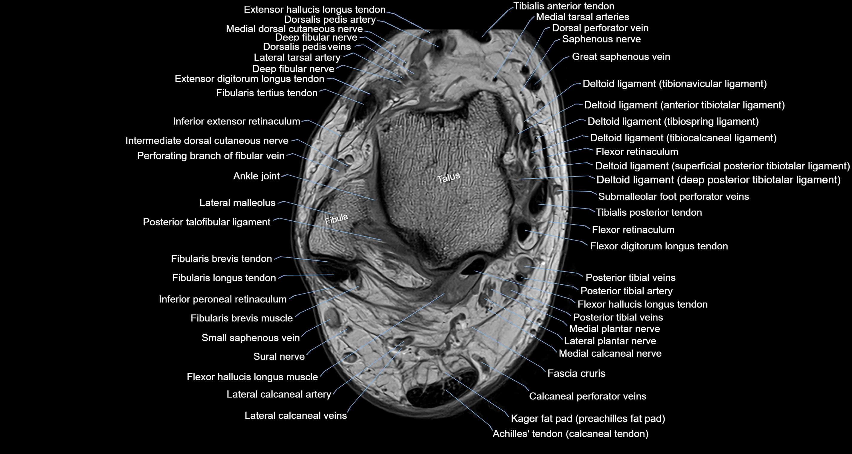 Ankle axial anatomy 3T MRI images -img-10001-00018.webp